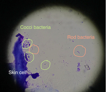 Bacteria in an ear under the microscope