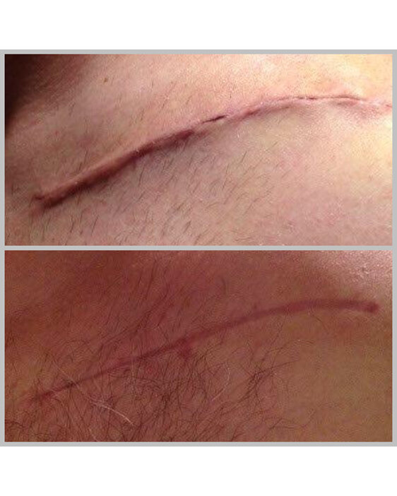 Example of Scar repair
