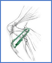 Extrascapular nylon procedure