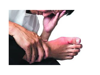 Gout Treatment Education and Consultation