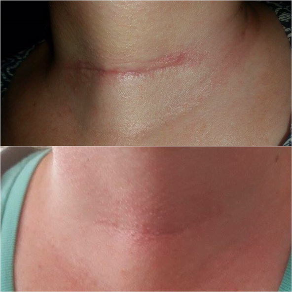 Stretch Markscar Repair Leesscience Dispensary