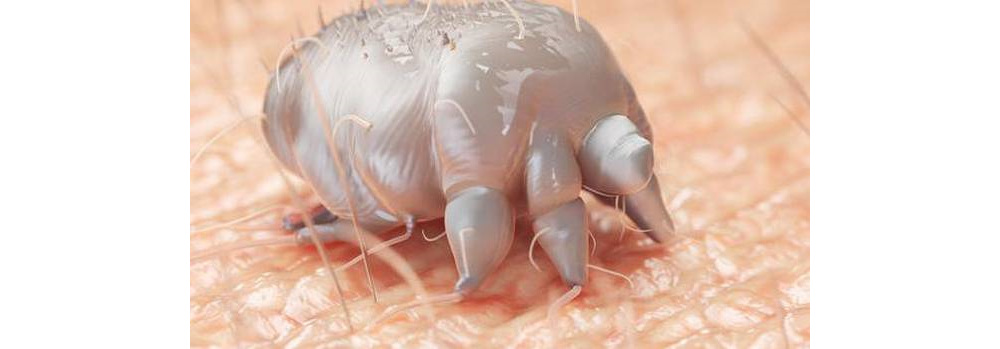 New research shows infestation with the parasitic scabies mite is linked with de
