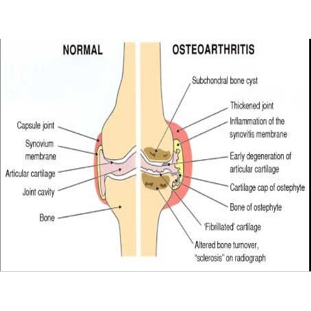 Oesteoarthritis