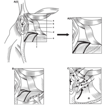 Perineal hernia repair diagram