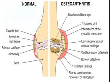 Schematic of Healthy Knee (Left) and Knee with Osetoarthritis