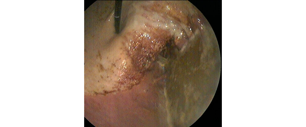 This image shows severe ulceration just above the margo plicatus.
